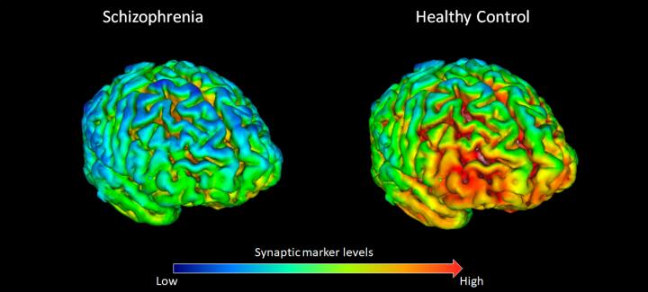 Synaptic Marker Protein SV2A is Reduced in Schizophrenia