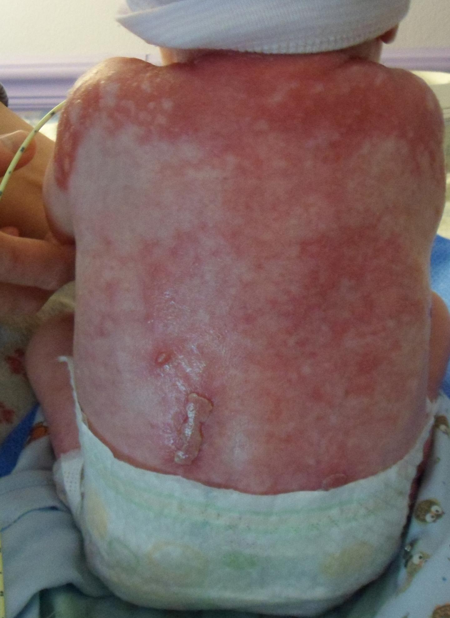 Child with AEC syndrome.