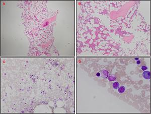 Bone marrow biopsy.