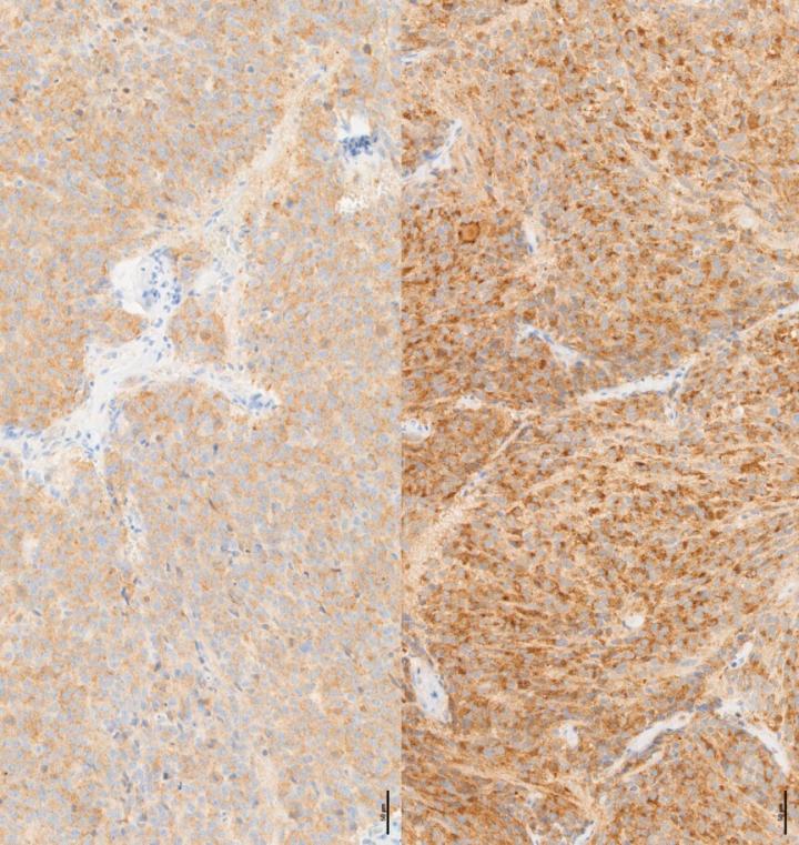 Neuroblastoma Tissues