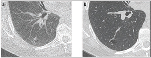 58-Year-Old Woman With Right Lower Lobe Nodule