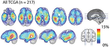 Glioblastoma Density Map