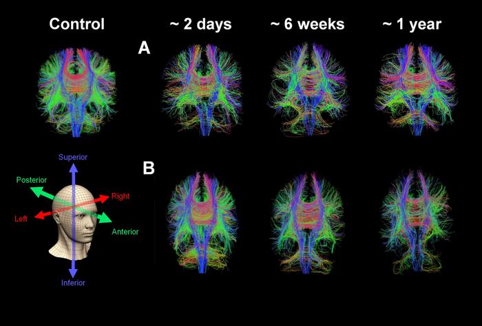 Whole brain diffusion tensor tractography