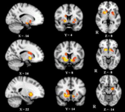 Increased Gray Matter Volume Was Observed