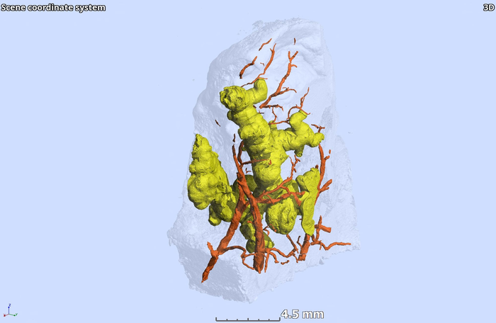 Three-dimensional Tb granuloma