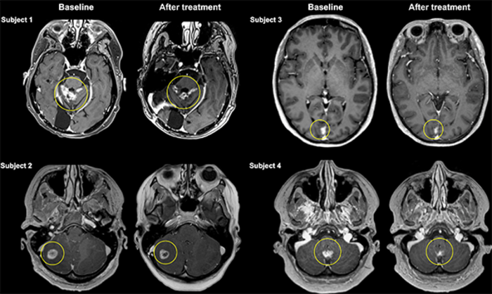 MR Images of Metastatic Tumor Reduction