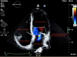 A labelled echo report image of a heart failure patient, as assessed by the study team's AI.