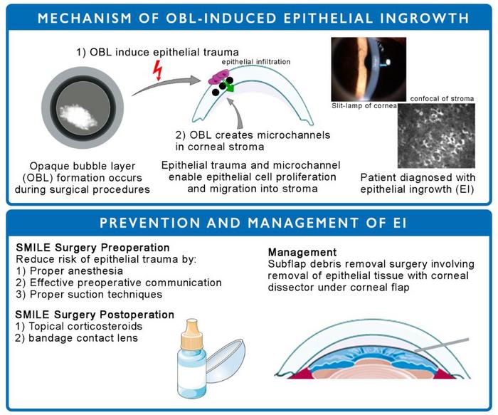 Mechanism of OBL-induced epithelial ingrowth