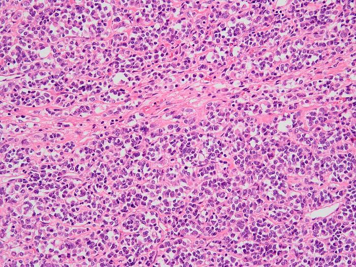 Small Cell Ovarian Carcinoma