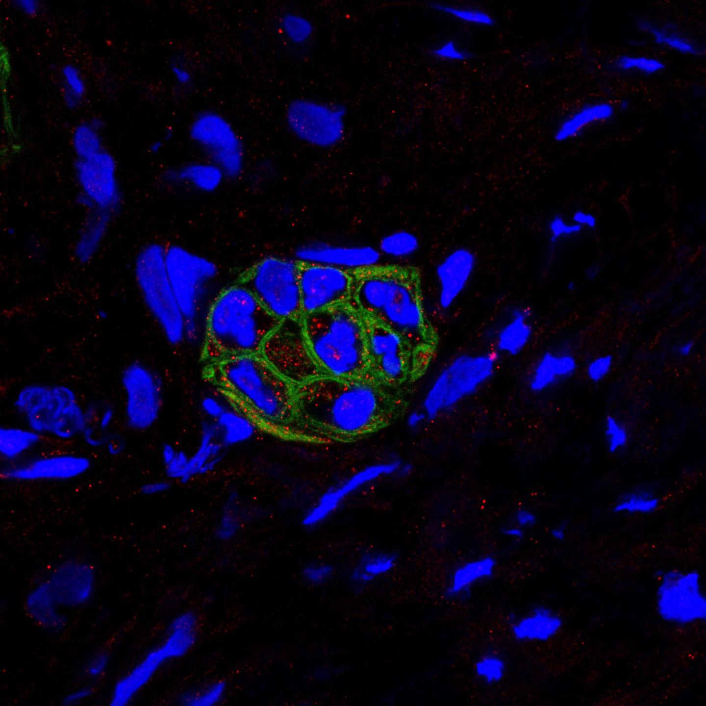 Human PDAC Tumors Showing Expressions