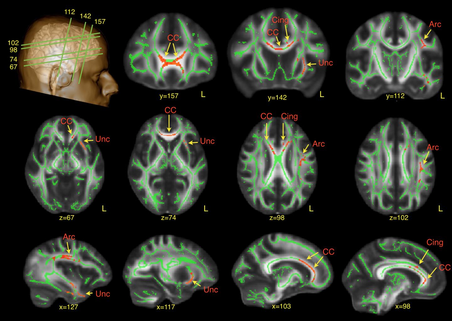 TBSS Analysis of Differences in Fractional Anisotropy