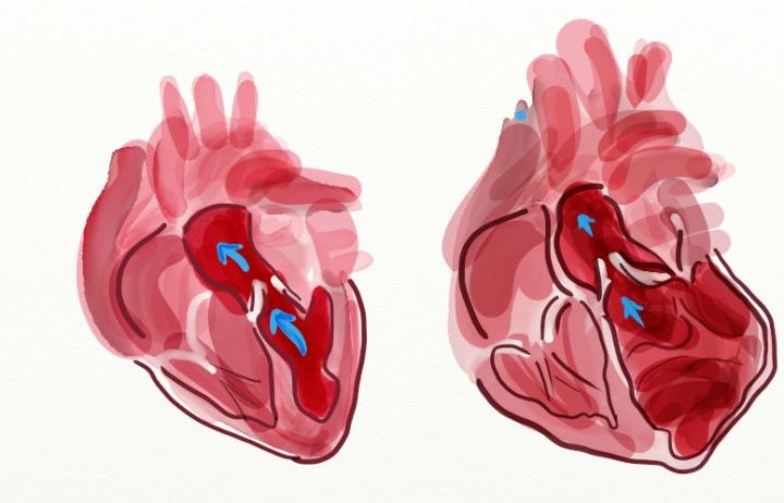 Dilated Heart