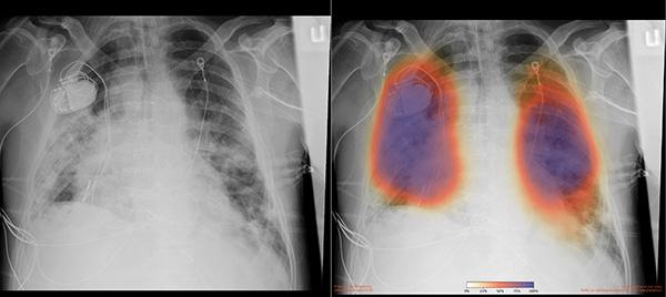 Chest X-Ray, COVID-19 Patient, University of California San Diego