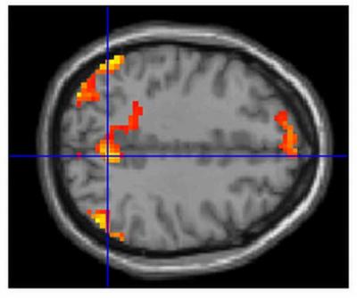 Brain Scan Showing Faulty 'Switch Off' Areas of the Brain
