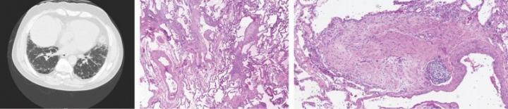 Protein Linked to Cancer Growth Drives Deadly Lung Disease