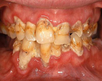 Meth Mouth