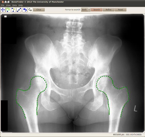Bonefinder Image (Hips)