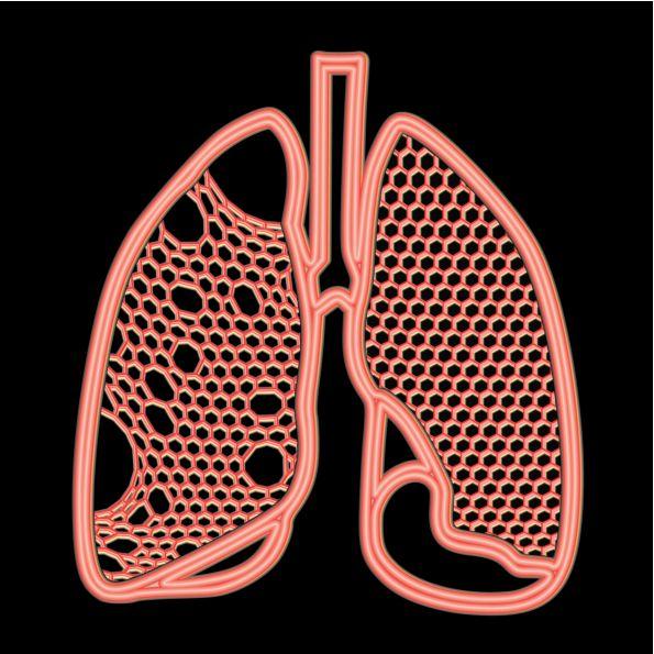 Emphysema Treatment Could be Optimized Using Network Modelling