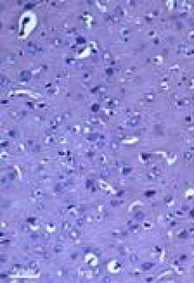 Cytotoxic Edema