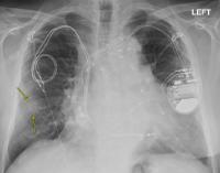 MRI Safely Performed in Patients with Pacemakers and ICDs
