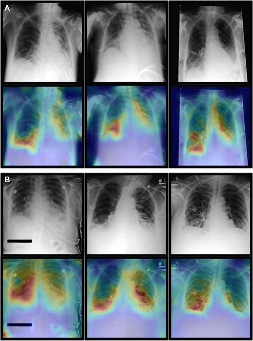 AI Combines Chest X-rays with Patient Data to Improve Diagnosis