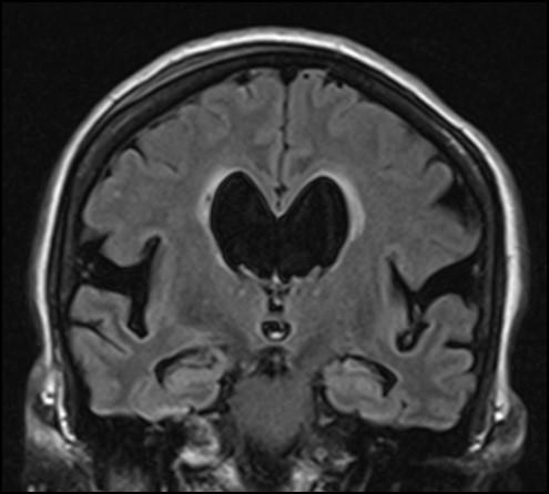 Idiopathic Normal Pressure Hydrocephalus