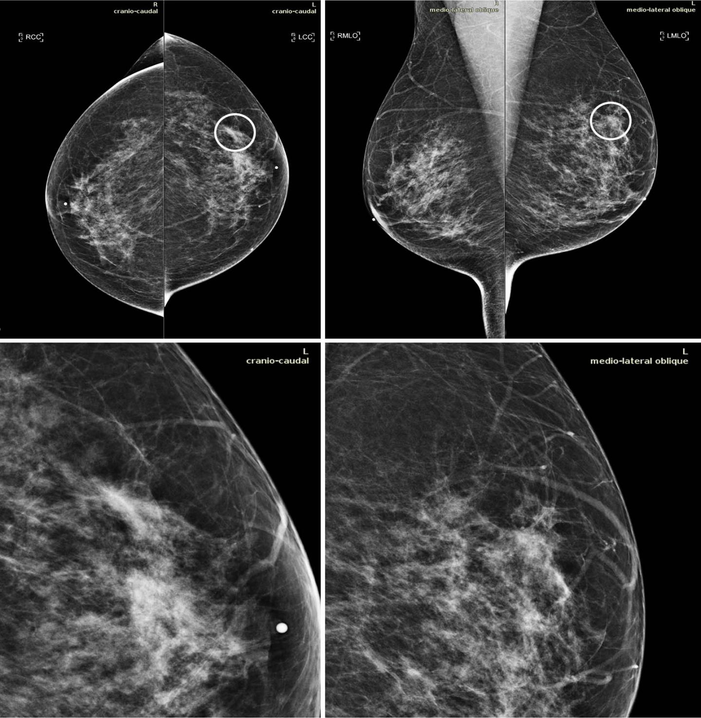 Breast Cancer  Mammogram 