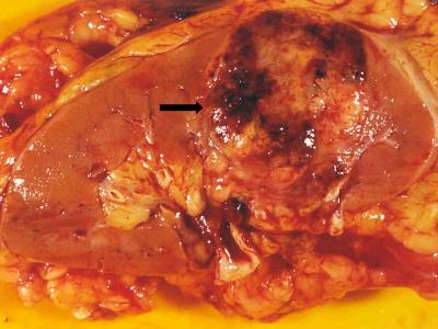 Renal Cell Carcinoma