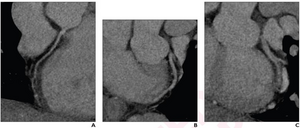 33-year-old, low risk of acute coronary syndrome, presents to off-hour ED with acute chest pain