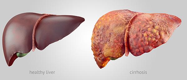 Healthy vs Cirrhotic Livers
