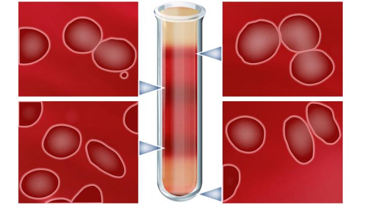 Cells Found in Sickle Cell Disease Blood Sample