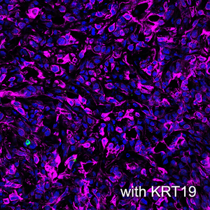 Cross-section of mouse pancreatic tumor tissue