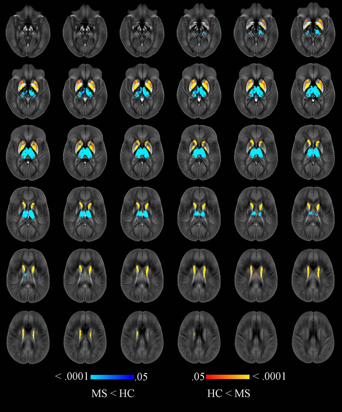 Quantitative Susceptibility Maps w/in Thalamus, Caudate, Globus Pallidus, & Putamen (1 of 3)