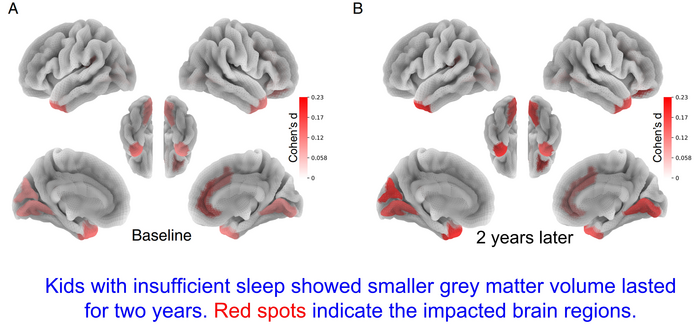 Gli effetti del sonno insufficiente sulle misurazioni strutturali del cervello