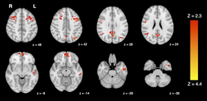                      First-in-the-world study suggests that even brief exposure to air pollution has rapid impacts on the brain                  image