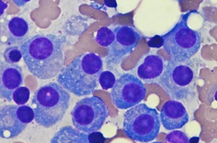 Bone marrow affected by multiple myeloma, a disease against which PVR inhibition can increase the efficacy of immunotherapy.