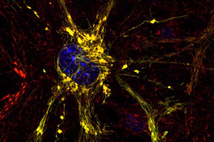 Charcot-Marie-Tooth Disease