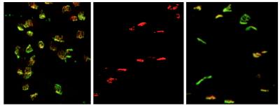 Study Identifies Gene Tied to Motor Neuron Loss in ALS