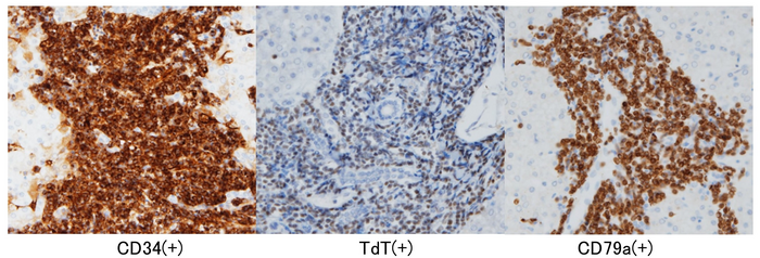 Successful Diagnosis of a Rare Disease in a Case of COVID-19-associated Sudden Unexplained Death in Childhood (IMAGE 1); (IMAGE 2); (IMAGE 3)