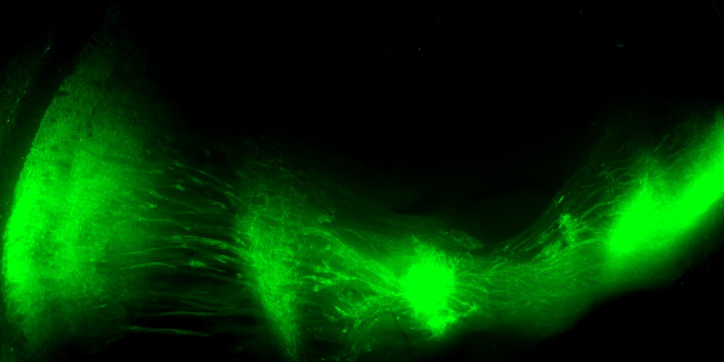 Striatonigral Pathway