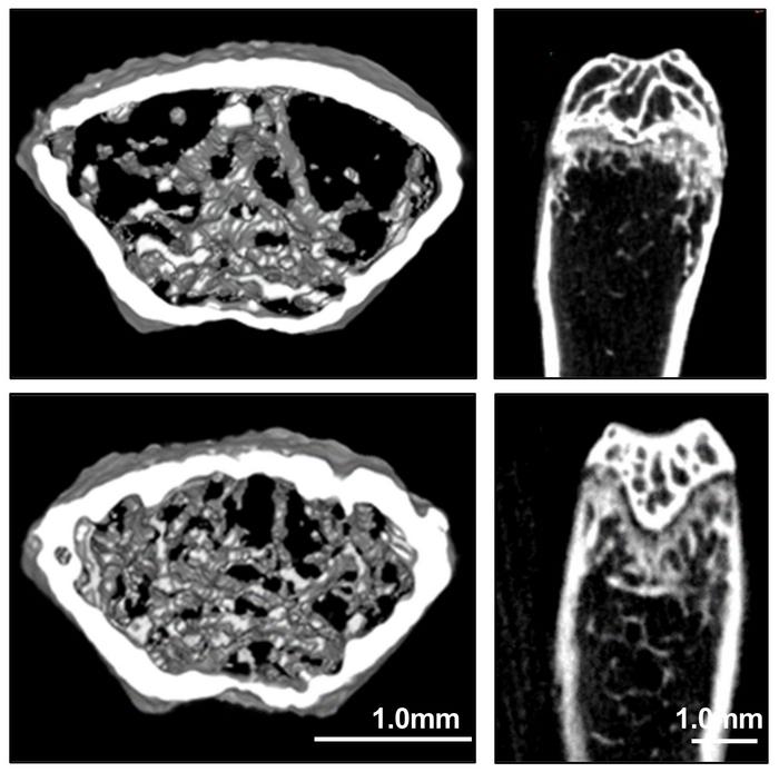 AI identifies antimalarial drug as possible osteoporosis treatment