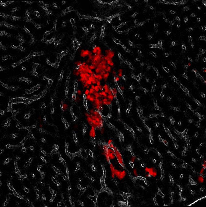 Spotting a Weakness in the Armor of an Aggressive Lung Cancer (4 of 5)