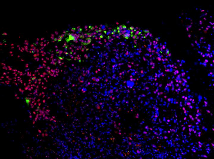 Zika Virus Targets Glioblastoma Stem Cells