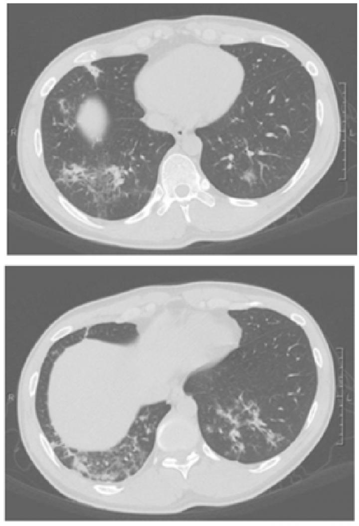 A Mutation in the <i>IKBKB</i> Gene Causes Bronchiectasis