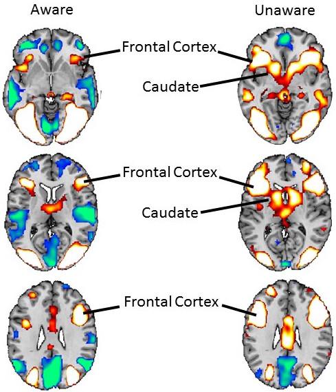 fMRI Images of Spider Phobic Individuals