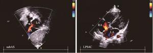 Subcostal view of the atrial septum (subAS) and low parasternal four-chamber view (LPS4C) (LA: left atrium; RA: right atrium).