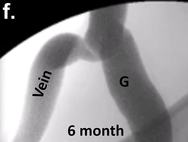 Biological Blood Vessel Grafts with No Living Parts Perform Well in Primates (4 of 7)