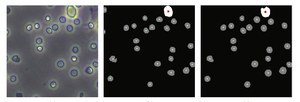 Machine learning radically reduces workload of cell counting for disease diagnosis