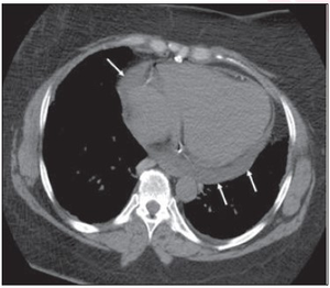 55-Year-Old Man Who Underwent Nephrectomy for Renal Cell Carcinoma