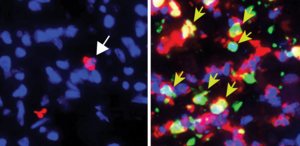 SURPRISE FINDING SHOWS THAT NEUTROPHILS CAN BE KEY ANTITUMOR WEAPONS